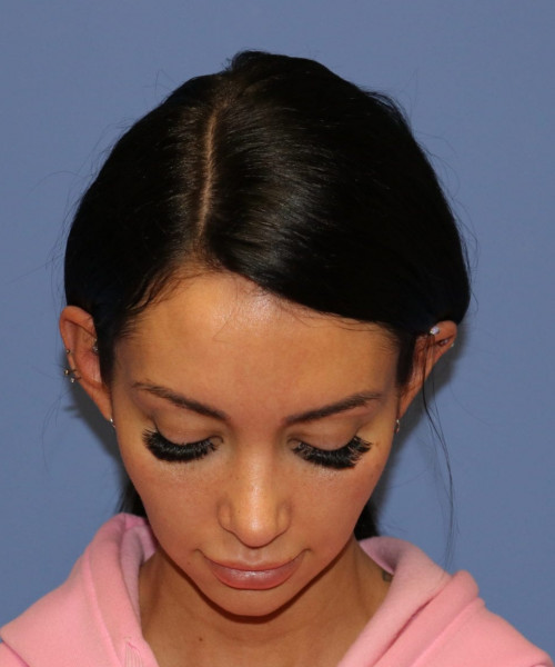 Rhinoplasty #7042 – click HERE for more views after photo. Individual results may vary.