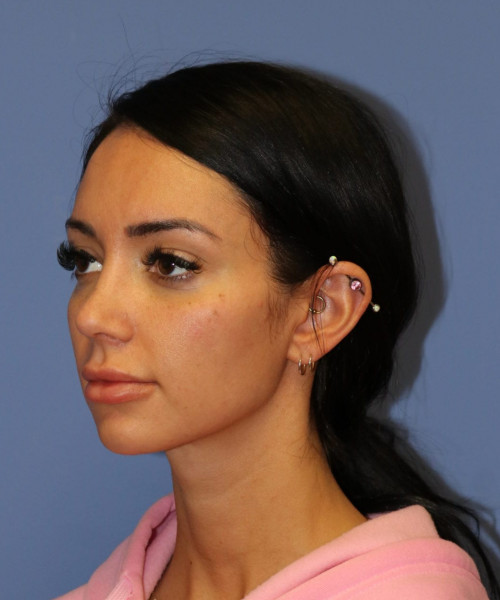 Rhinoplasty #7042 – click HERE for more views after photo. Individual results may vary.
