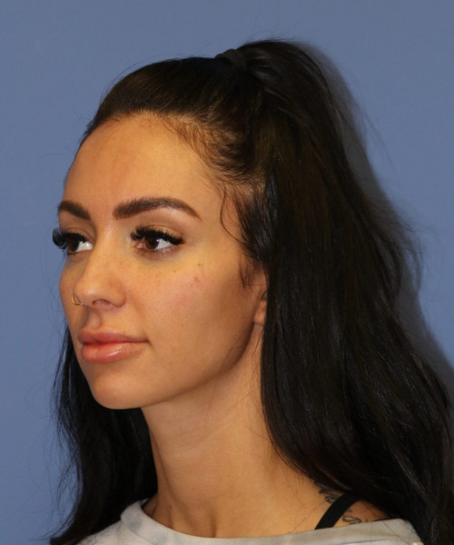 Rhinoplasty #7042 – click HERE for more views before photo. Individual results may vary.