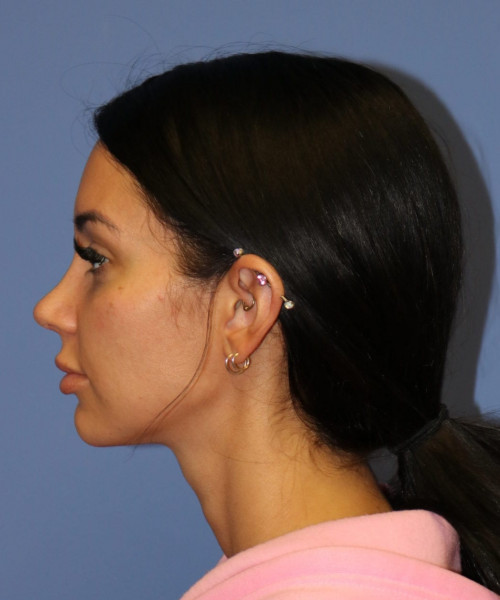 Rhinoplasty #7042 – click HERE for more views after photo. Individual results may vary.