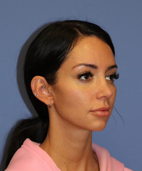 Rhinoplasty #7042 – click HERE for more views after photo. Individual results may vary.