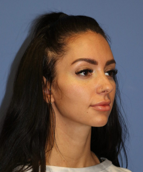 Rhinoplasty #7042 – click HERE for more views before photo. Individual results may vary.