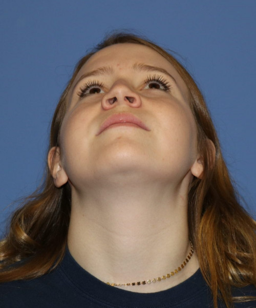 Rhinoplasty #7164 – click HERE for more views before photo. Individual results may vary.
