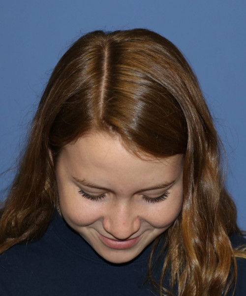 Rhinoplasty #7164 – click HERE for more views before photo. Individual results may vary.