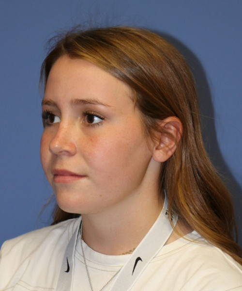 Rhinoplasty #7164 – click HERE for more views after photo. Individual results may vary.