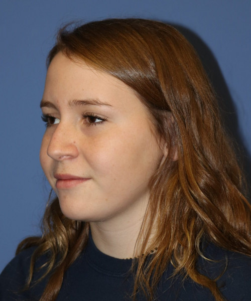 Rhinoplasty #7164 – click HERE for more views before photo. Individual results may vary.