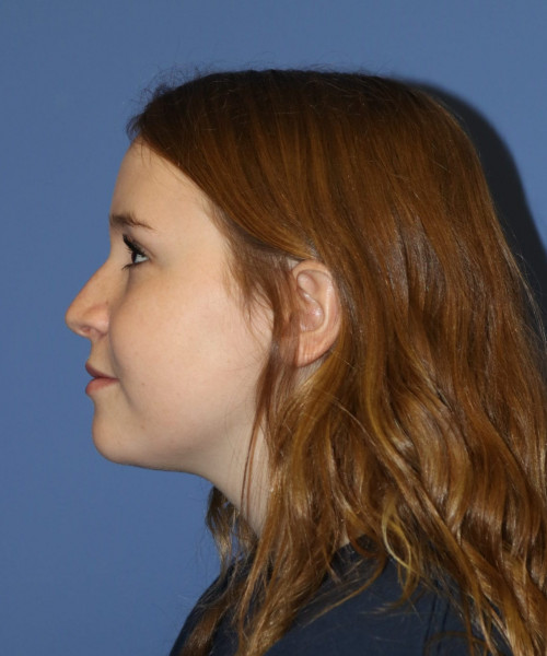 Rhinoplasty #7164 – click HERE for more views before photo. Individual results may vary.