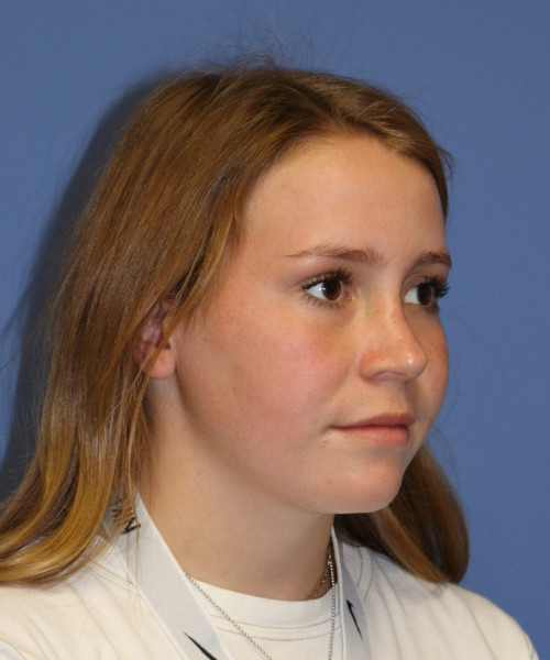 Rhinoplasty #7164 – click HERE for more views after photo. Individual results may vary.
