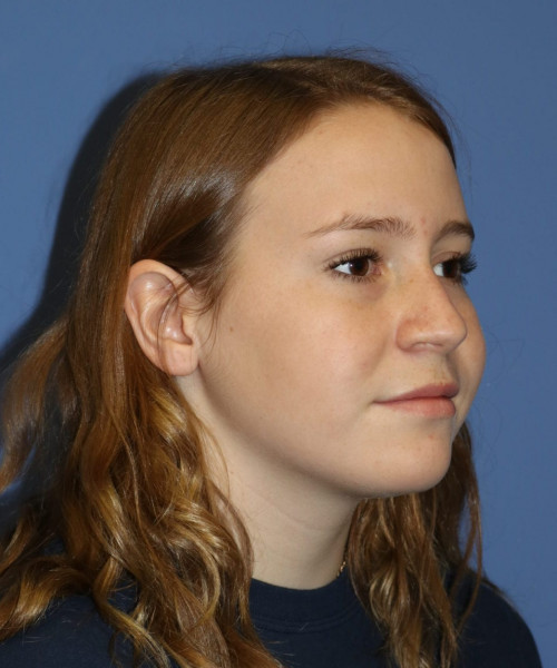Rhinoplasty #7164 – click HERE for more views before photo. Individual results may vary.