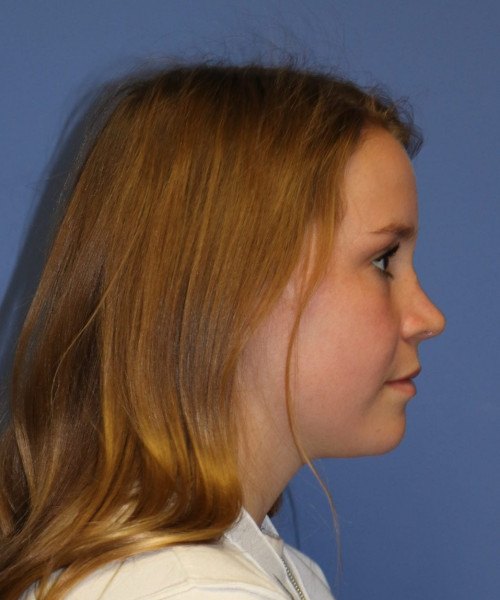 Rhinoplasty #7164 – click HERE for more views after photo. Individual results may vary.
