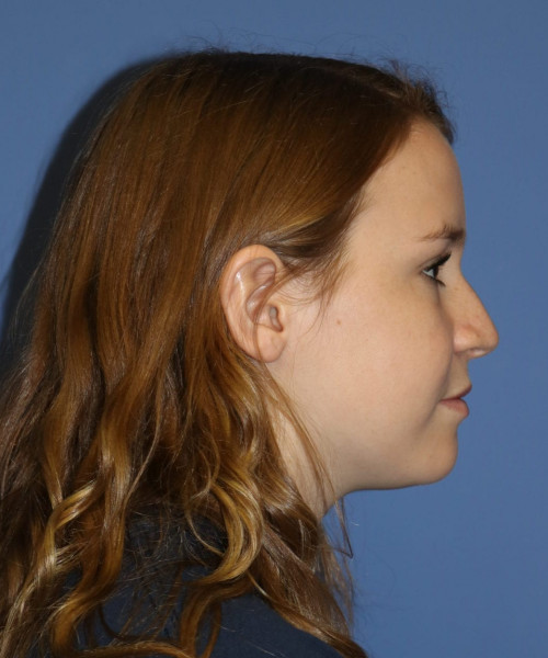 Rhinoplasty #7164 – click HERE for more views before photo. Individual results may vary.