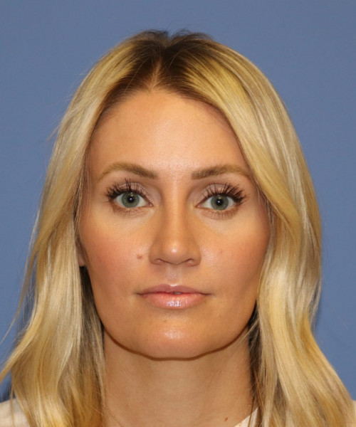 Rhinoplasty #7245 – click HERE for more views after photo. Individual results may vary.