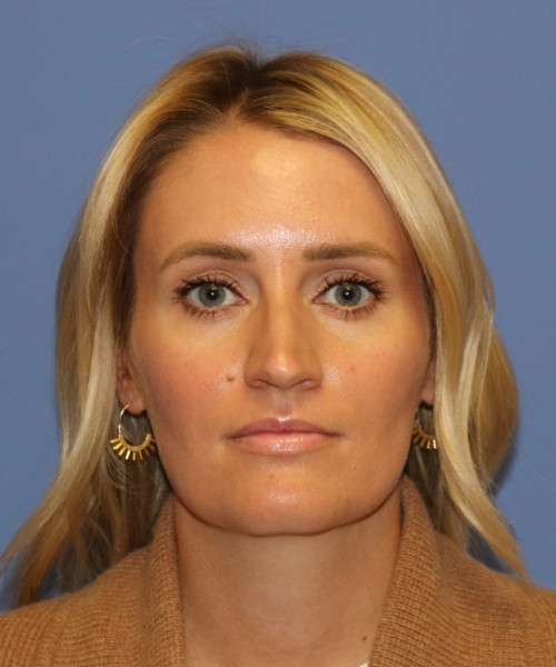 Rhinoplasty #7245 – click HERE for more views before photo. Individual results may vary.