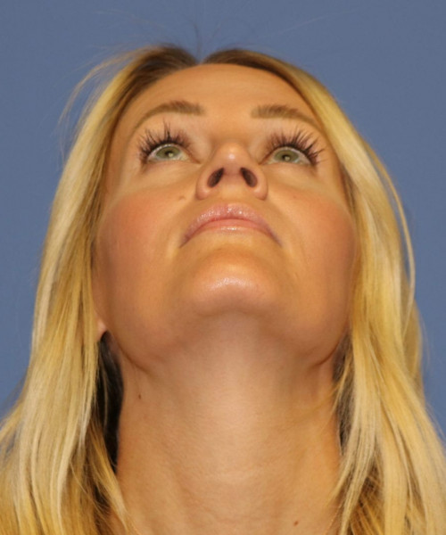Rhinoplasty #7245 – click HERE for more views after photo. Individual results may vary.