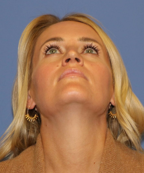 Rhinoplasty #7245 – click HERE for more views before photo. Individual results may vary.