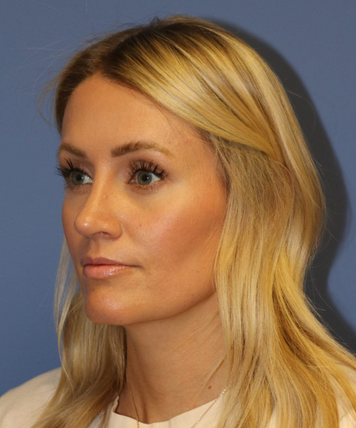 Rhinoplasty #7245 – click HERE for more views after photo. Individual results may vary.