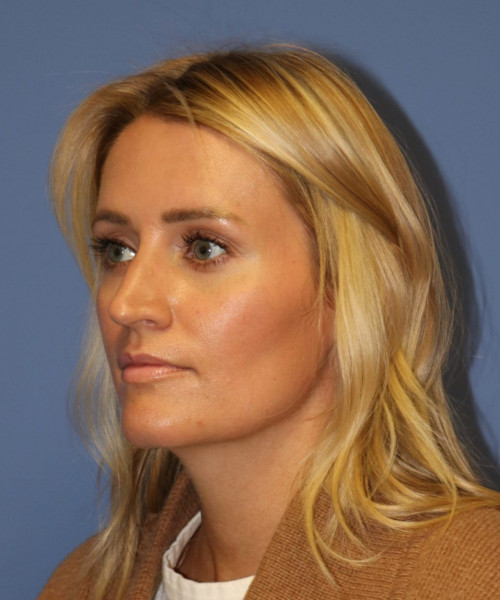 Rhinoplasty #7245 – click HERE for more views before photo. Individual results may vary.