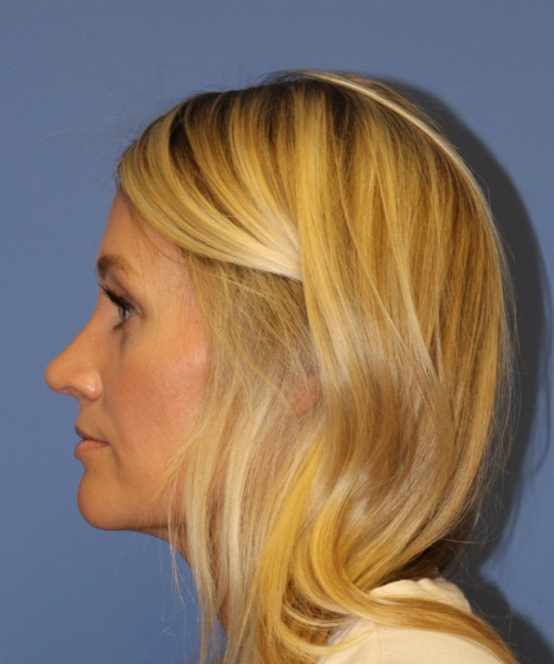 Rhinoplasty #7245 – click HERE for more views after photo. Individual results may vary.