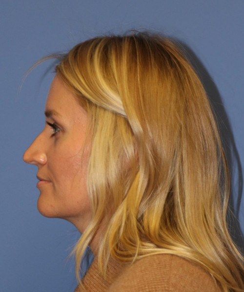 Rhinoplasty #7245 – click HERE for more views before photo. Individual results may vary.