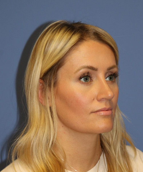 Rhinoplasty #7245 – click HERE for more views after photo. Individual results may vary.
