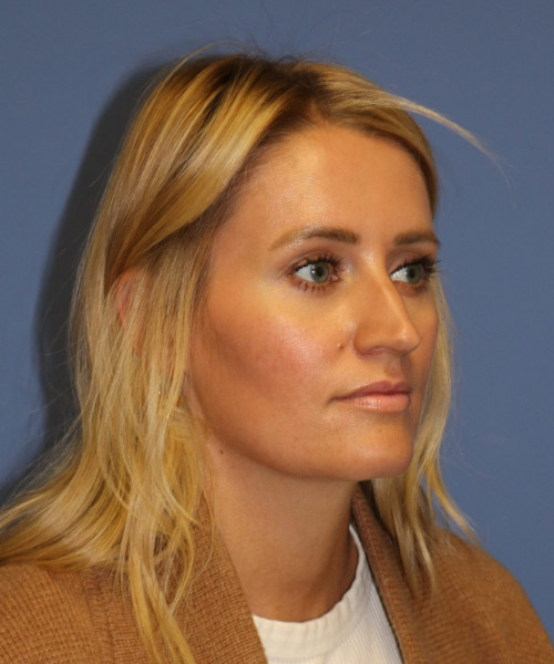 Rhinoplasty #7245 – click HERE for more views before photo. Individual results may vary.