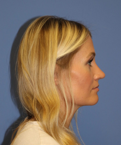 Rhinoplasty #7245 – click HERE for more views after photo. Individual results may vary.