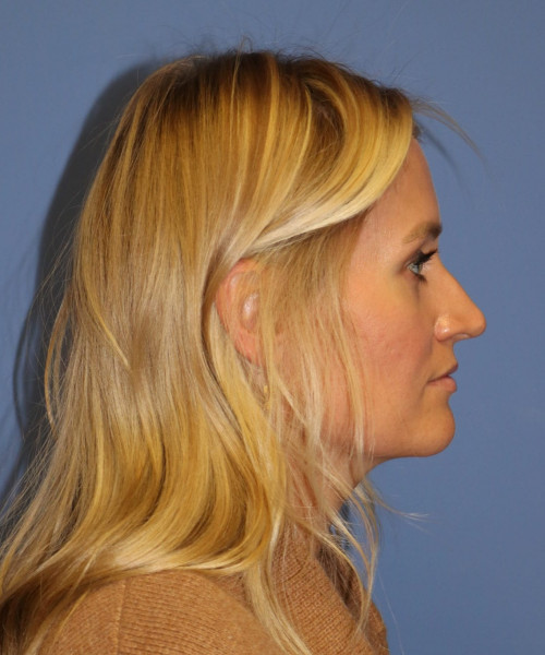 Rhinoplasty #7245 – click HERE for more views before photo. Individual results may vary.