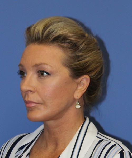 Facelift 0739 – Click HERE for more views after photo. Individual results may vary.