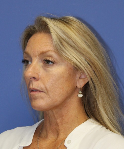Facelift 0739 – Click HERE for more views before photo. Individual results may vary.