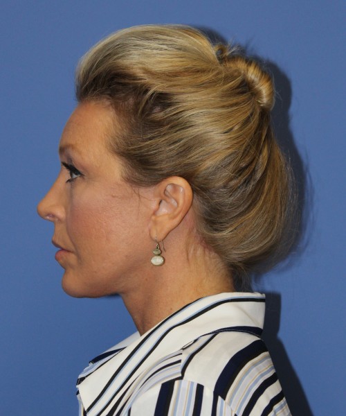 Facelift 0739 – Click HERE for more views after photo. Individual results may vary.