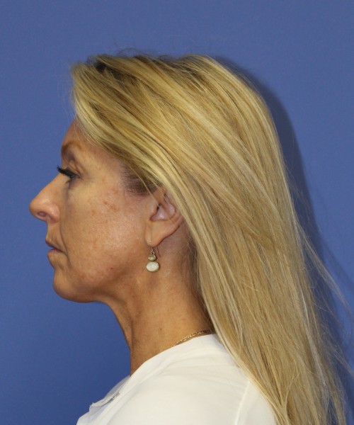 Facelift 0739 – Click HERE for more views before photo. Individual results may vary.
