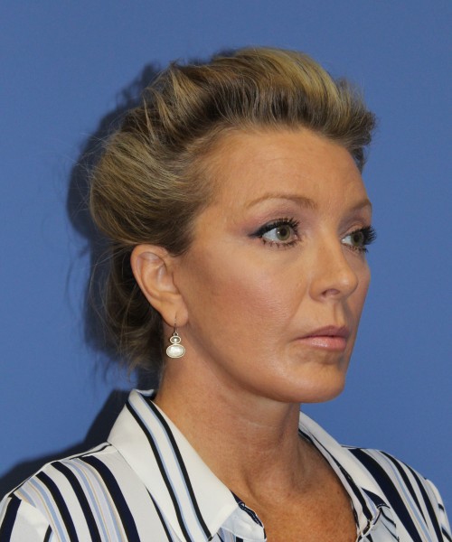 Facelift 0739 – Click HERE for more views after photo. Individual results may vary.
