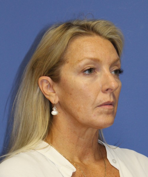 Facelift 0739 – Click HERE for more views before photo. Individual results may vary.