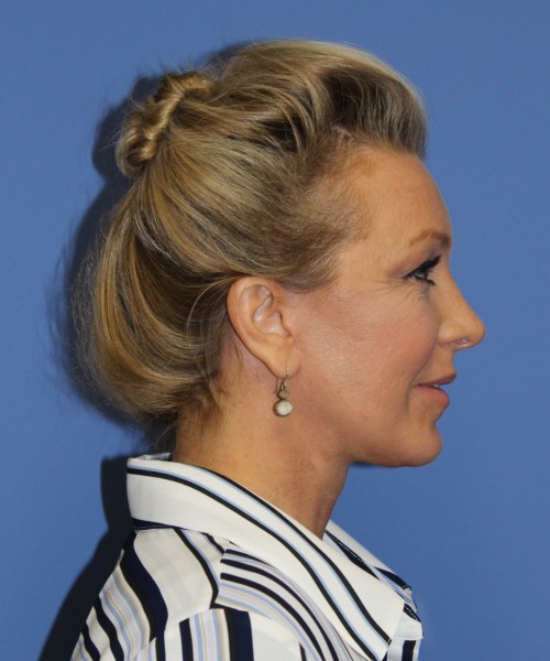 Facelift 0739 – Click HERE for more views after photo. Individual results may vary.
