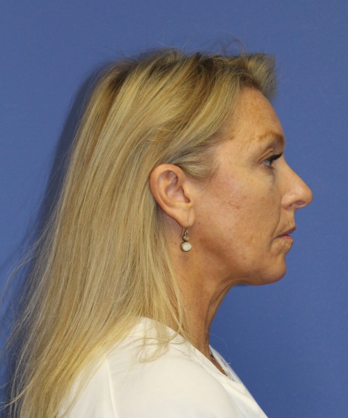 Facelift 0739 – Click HERE for more views before photo. Individual results may vary.