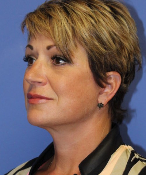 Facelift 0781 – Click HERE for more views after photo. Individual results may vary.