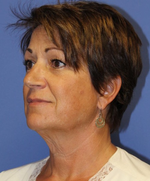 Facelift 0781 – Click HERE for more views before photo. Individual results may vary.