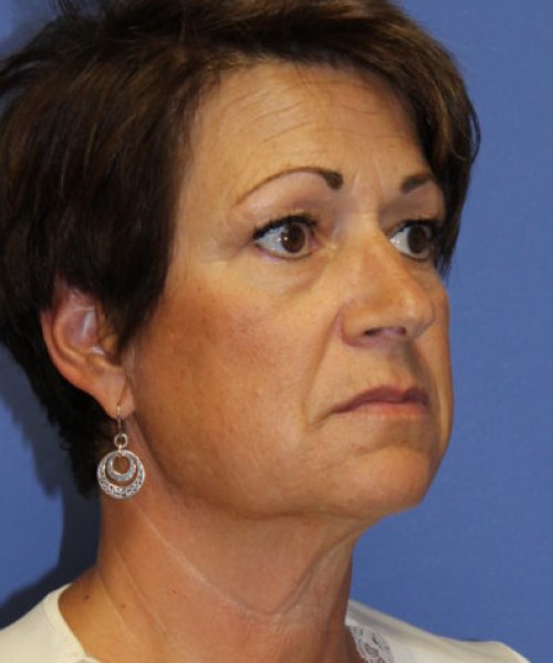 Facelift 0781 – Click HERE for more views before photo. Individual results may vary.