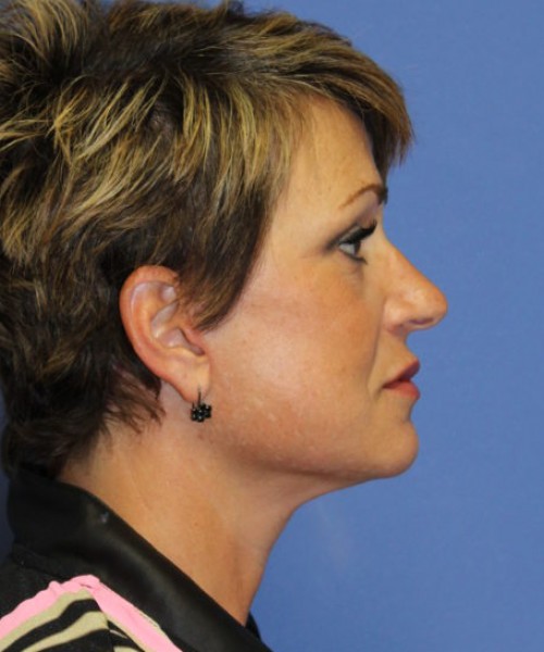 Facelift 0781 – Click HERE for more views after photo. Individual results may vary.