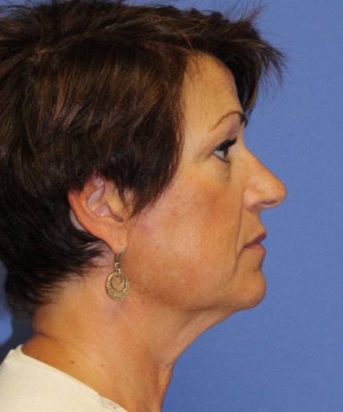 Facelift 0781 – Click HERE for more views before photo. Individual results may vary.