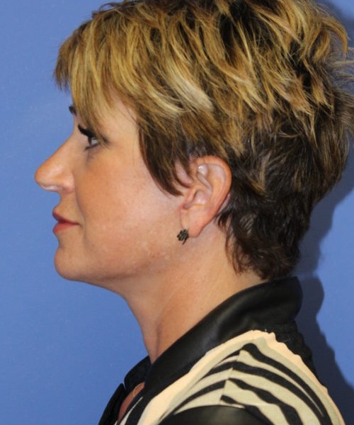 Facelift 0781 – Click HERE for more views after photo. Individual results may vary.