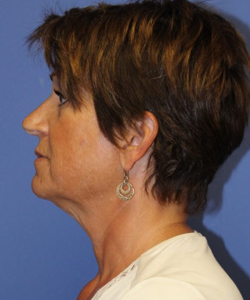 Facelift 0781 – Click HERE for more views before photo. Individual results may vary.